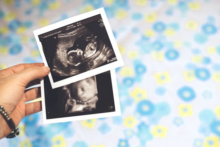 ultrasound, fetus, baby, pro-life