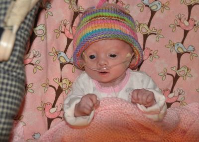 Melody who was born 4 lbs and 14 oz with trisomy 18.