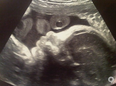 shakira ultrasound photos