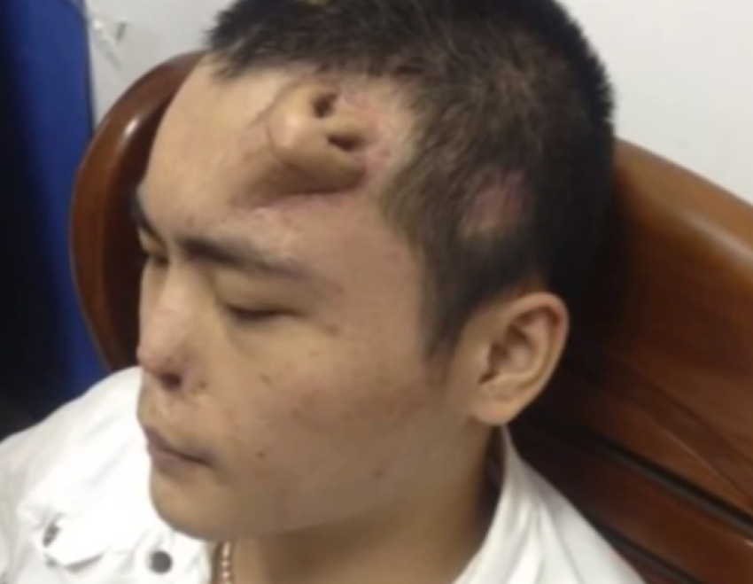 A man's forehead has been the place where China medics chose to grow a replacement nose for him.