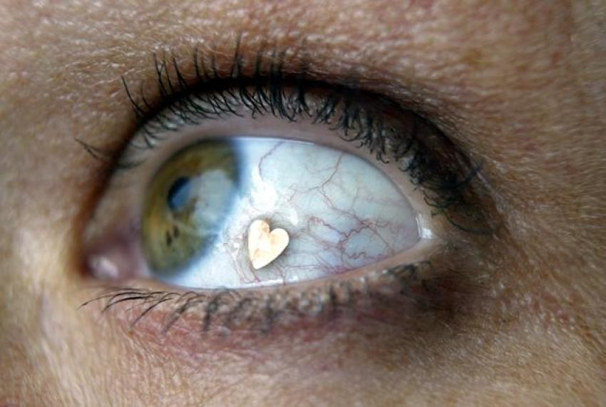 Deborah Boer models the "Jewel Eye" in her hometown of Driebergen, the Netherlands in 2004. The surgical eyeball jewelry implant fad made its way to New York a few weeks ago.