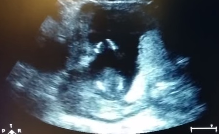 Unborn baby clapping