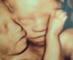 Mother Who Gives Birth to Conjoined Twins Gives Glory to God Even After One Baby Dies in Surgery