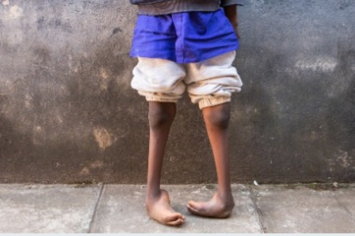 How we can kick Clubfoot for good
