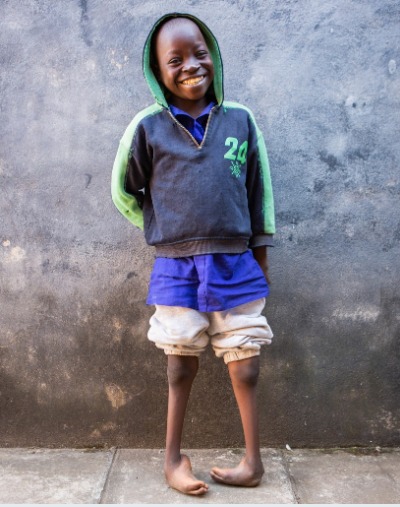 How we can kick Clubfoot for good - Vimarsana News