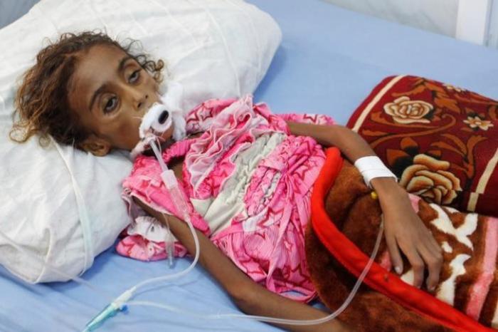 Malnourished girl Jamila Ali Abdu, 7, lies on a hospital bed before she died in the Red Sea port city of Hodeidah, Yemen May 2, 2017.