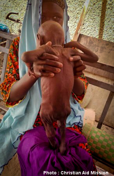 A malnourished boy's mother brought him to a modern medical clinic in Niger in this undated photo.