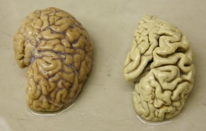 A comparison of a healthy brain hemisphere (left) compared to a hemisphere of the brain of an Alzheimer's Disease patient.