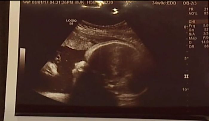(Photo: A Pa. couple sees Jesus in their sonogram in a video posted by Fox 43 on August 22, 2017.)