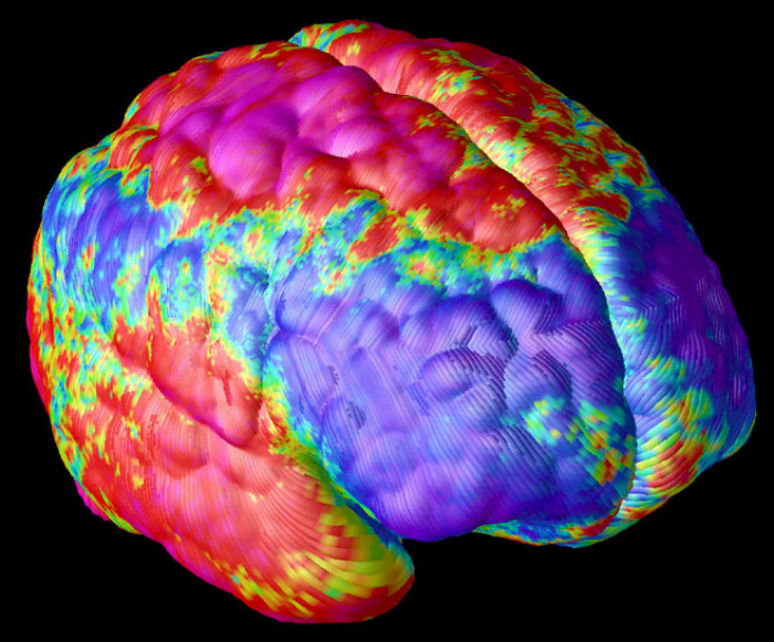 A false color image of a schizophrenic brain