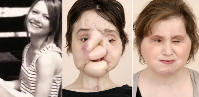 Katie Stubblefield (L) before she shot herself in the face. Katie after the injury (C) and Katie as she now appears after a full face transplant (R).