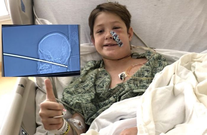 Xavier Cunningham, 10, of Missouri, survived being impaled in the face by a foot long meat skewer. (Inset) an x-ray of his injury.
