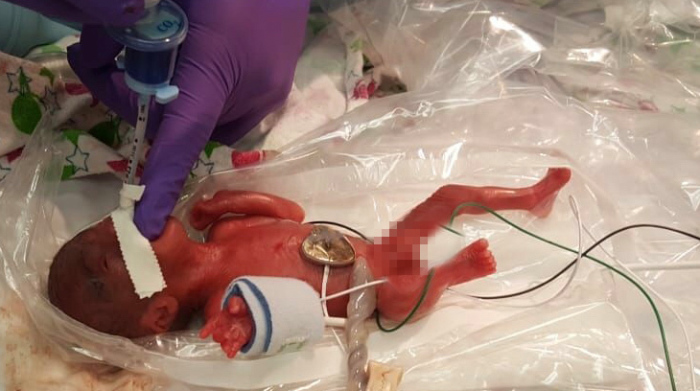 Baby Saybie who is believed to be the world's smallest surviving newborn weighed just 8.6 ounces at birth.