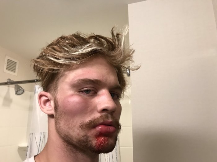 Taylor Hansen shows his bloody face in a photo posted to Twitter on Sept. 9, 2020. 