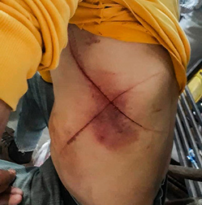 A 'cross' is etched into the skin of a Venezuelan Christian after an attack in Venezuela’s Mérida State that was reported by Open Doors UK in February 2020. 