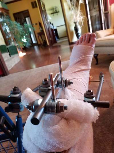 Michael Robertson's foot and leg after the motocycle accident 