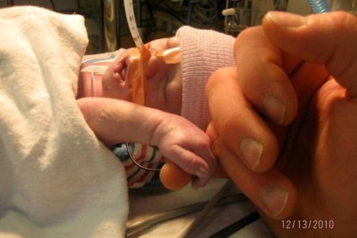 Baby Beatrix was born on Dec. 13, 2010, with a condition known as Limb Body Wall Complex.