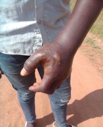 Hand injuries Robert Faisali Miya sustained in Aug. 11, 2023, assault in Busolwe, Uganda.