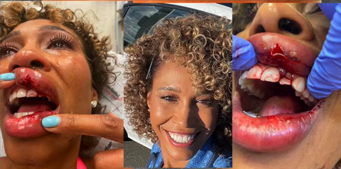 Sports anchor Sage Steele shared photos taken after she got hit in the mouth by a wayward gold ball in May 2022 while speaking at Liberty University on March 20, 2024. 