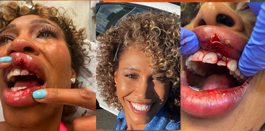 Sports anchor Sage Steele shared photos taken after she got hit in the mouth by a wayward gold ball in May 2022 while speaking at Liberty University on March 20, 2024.