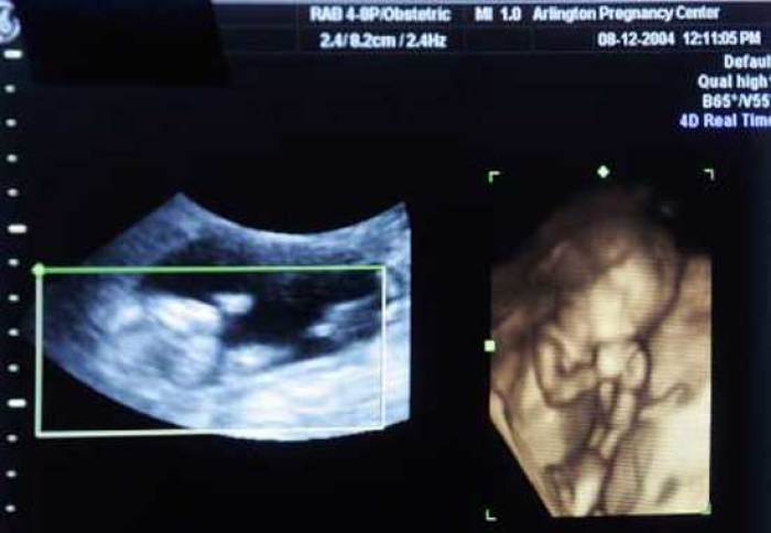 A four dimensional ultrasound is seen at a pregnancy clinic in Arlington, Texas.