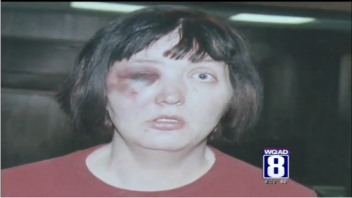 Brandie Redell after a brutal battering from officers from the Davenport Police Department in Iowa.