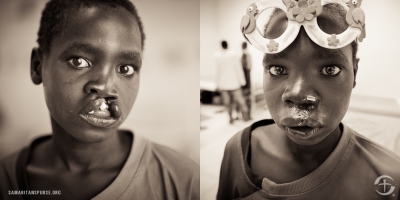 South Sudan boy in this undated 'before and after' photo of cleft lip surgery.