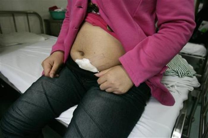 Xiao Hong, a young Chinese surrogate mother who said she was forced into an abortion by district family planning officers in Guangzhou, displays the scar on her pregnant abdomen where she said she was injected with a drug on Feb. 28, 2009.