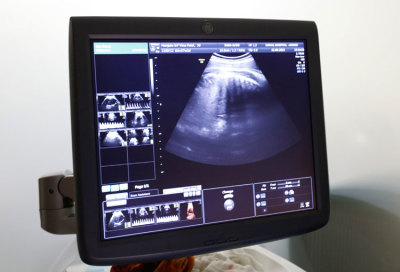 An ultrasound image is seen on a monitor, August 24, 2013.