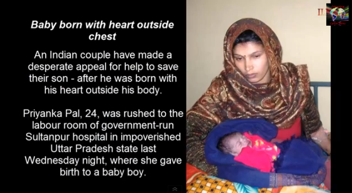A baby boy born in India with his heart outside his chest.