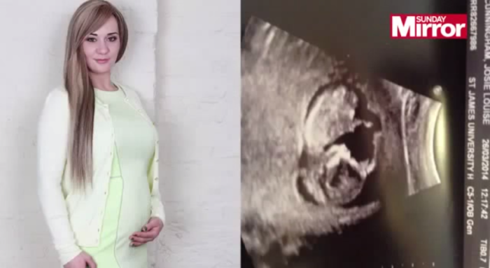 Model Josie Cunningham, 23 (l) and her unborn child (r).