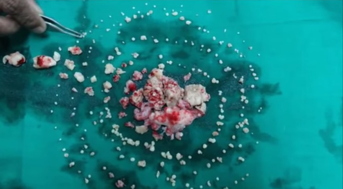 The 232 teeth removed from Ashiq Gavai's mouth.