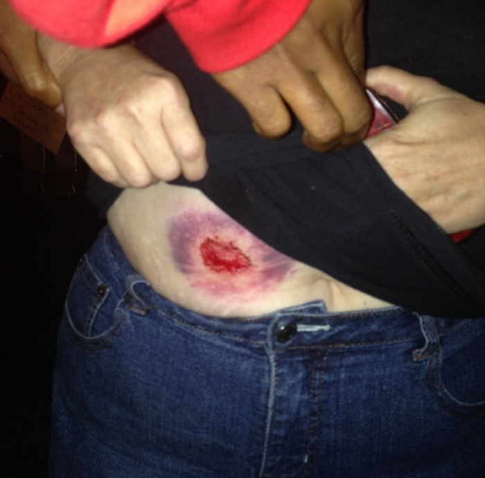 Pastor Renita Lamkin's injury after being shot by a rubber bullet.