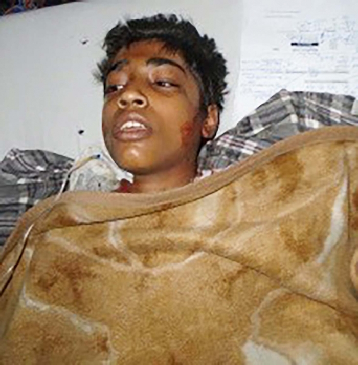Nouman Masih suffered burns covering more than 55 percent of his body.