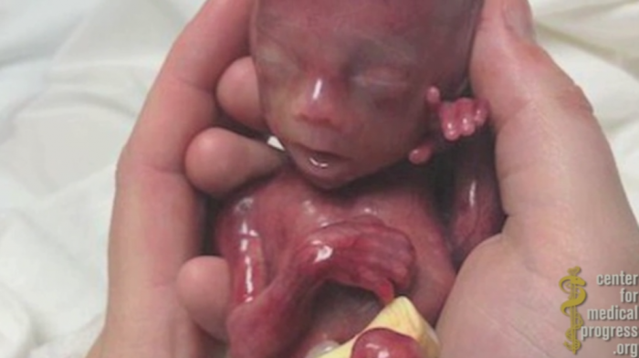 Image is not aborted baby but the premature birth of Walter Fretz in Pennsylvania.