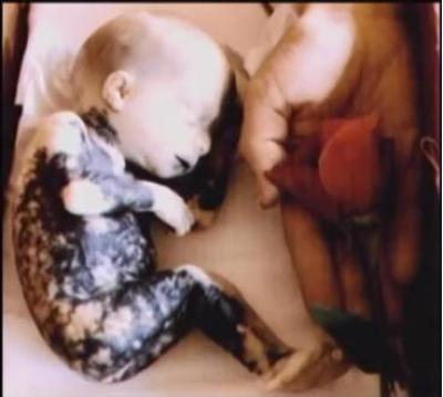 Screengrab of the picture Gianna Jessen showed the House Judiciary Committee on Sept. 9, 2015 to explain the effect saline abortion had on her infant body.