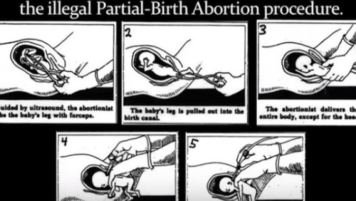 Diagram of a partial-birth abortion procedure.
