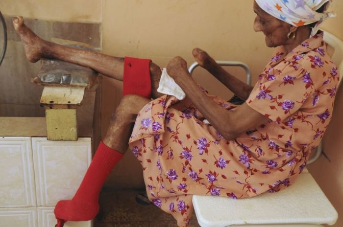 Julia Ramirez, a 74-year-old leprosy affected woman, puts on her socks at the isolated village of Nigua in the Leprocomio (Leprosy hospital), south of Santo Domingo, July 9, 2012. More than 300 lepers and recovered lepers live, with the government's support, in the isolated village founded by Catholic nuns 90 years ago. Leprosy, or Hansen's disease, is caused by the bacteria Mycobacterium leprae.