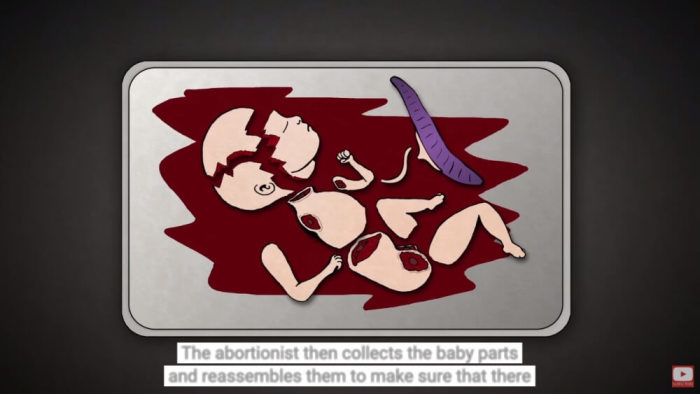 Dilation and evacuation abortion animation