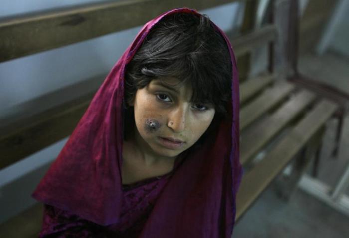 Sahima, 10, with a sore on her cheek, waits for treatment at a clinic in Kabul April 29, 2007.