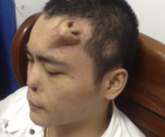 Forehead Nose? Man Grows Nose on His Forehead After Crash (VIDEO, PHOTO)