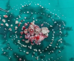 Doctors Extract Surprising 232 Teeth From Mouth of Teen Boy; Will Submit Case to Guinness World Record