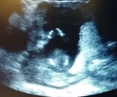 This Unborn Baby Does Something That Made Everyone Smile!