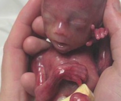 Baby In Undercover Anti-Abortion Video Was Stillborn, Not Aborted, Producer Says