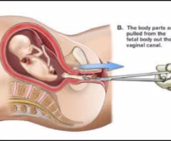Alabama Becomes Fifth State to Ban Dismemberment Abortions