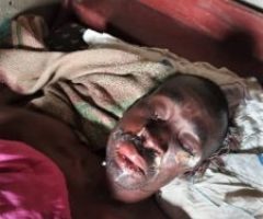 Pastor attacked with acid in Uganda after preaching sermon