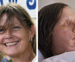 Charla Nash Face Transplant Revealed After Chimapanzee Attack