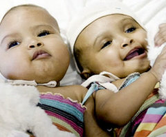 Conjoined Twins Successfully Separated, Defying 1 in 10M Odds
