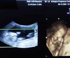 Ultrasound Technology: An Effective Piece of the Pro-Life Message